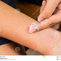 lam diu vet con trung can